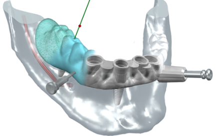 illustration Implants dentaire : la chirurgie guidée